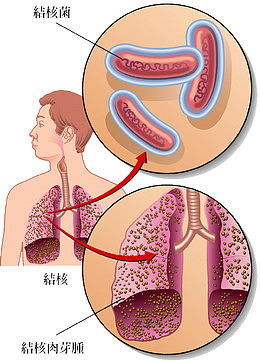 结核病结构