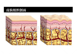 皮肤组织创面
