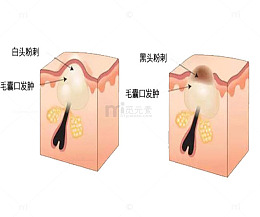 毛孔粗大