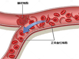 血红细胞示意图