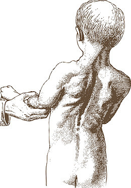 孩子矫正脊柱侧弯