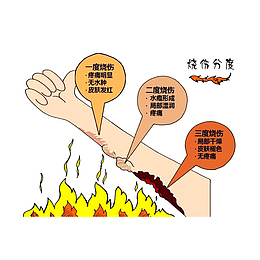 烧伤分度