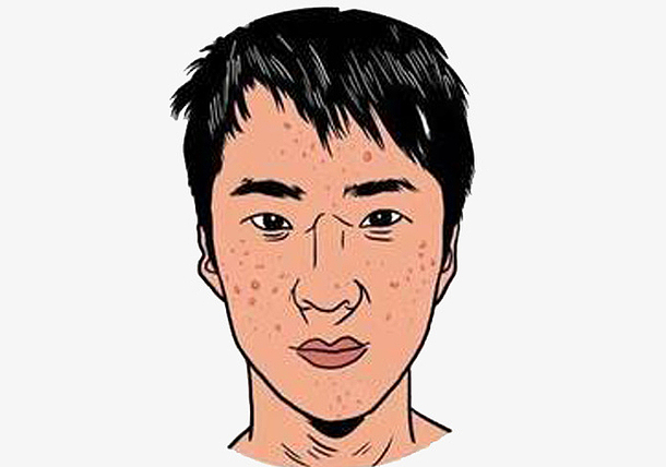 长痘痘男人满脸痘痘