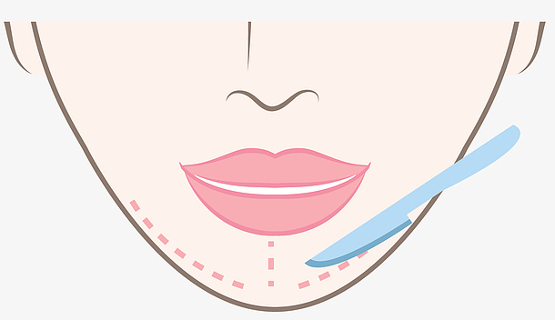 关键词 : 整形,卡通整形,矢量,扁平风格,尖下巴,手术整形,整形手术
