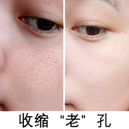 毛孔粗大