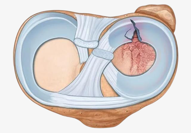 膝盖 半月板 半月板损伤 损伤