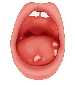 手绘口腔溃疡