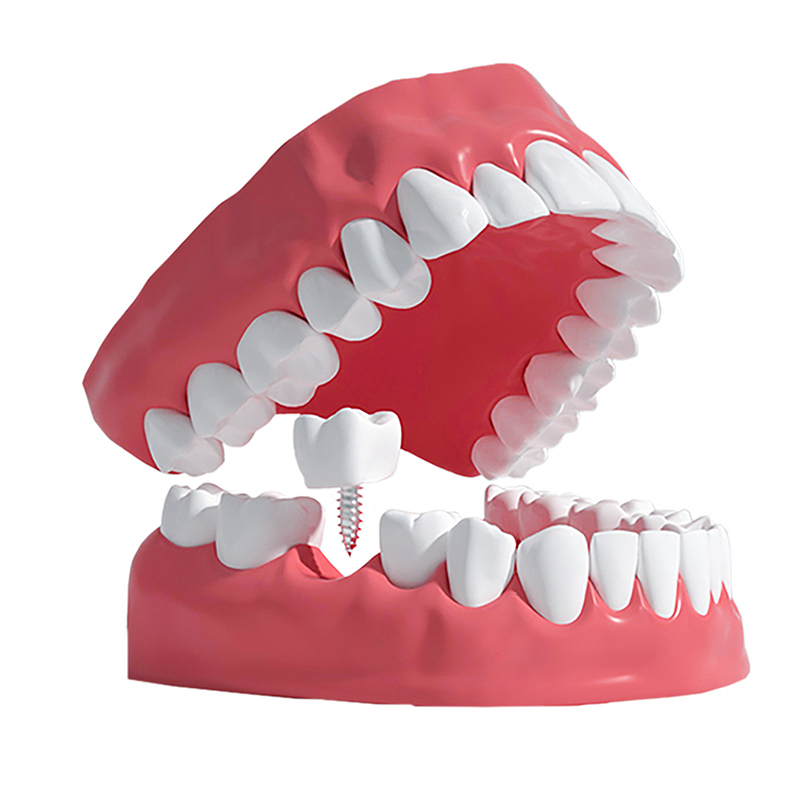 牙齿种植模型